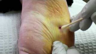 Surgical Plantar Wart Removal [upl. by Anid]