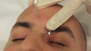 Sebaceous Hyperplasia Treatment using Electrodessication [upl. by Llorrad366]