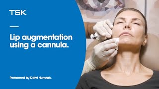 Lip augmentation Cannula technique by Dr Dalvi Humzah [upl. by Eilyac406]