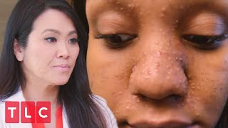 Tiny Bumps All Over Her Face  Dr Pimple Popper Before the Pop [upl. by Assyl]