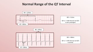 Advanced EKGs  The QT Interval and Long QT Syndrome [upl. by Ocsisnarf]