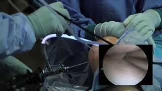 Arthroscopic Knee Surgery Meniscus Tear [upl. by Aititel815]