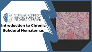 Introduction to Chronic Subdural Hematomas [upl. by Shriner]