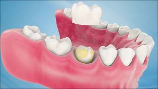 Dental Crown Procedure [upl. by Atteram]