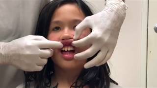 Frenectomy lip and tongue exercises tutorial [upl. by Nerte]