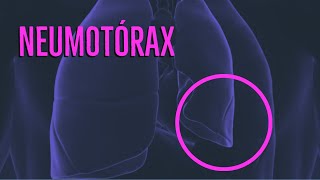 Neumotórax neumomediastino neumopericardio y enfisema subcutáneo [upl. by Axela]