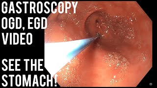 Capsule Endoscopy a helping hand [upl. by Norrad26]