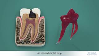 Endodontic treatments [upl. by Yorke]