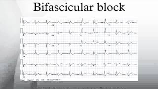 Bifascicular block [upl. by Sremmus102]