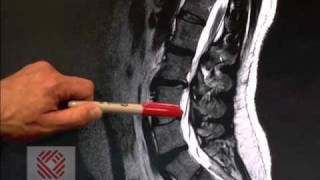 Low Back Pain Part 8 Spinal Stenosis [upl. by Greenebaum]