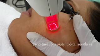 Laser treatment for acne scars  Fractional Non Ablative Laser  Dr Anuj Pall MD PhD FISD USA [upl. by Rafaelia]