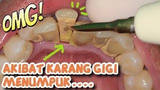 Untuk Kamu yang Belum Pernah Scaling Jangan Sampai Seperti Ini  Dokter Gigi Tri Putra [upl. by Coughlin209]