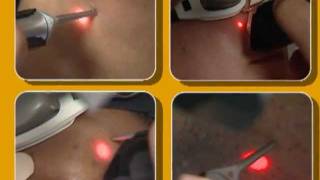 Laser Hair Removal video by Cynosure [upl. by Hung352]