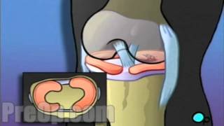 Arthroscopic Meniscus Repair of Knee Medical Surgery Patient Education [upl. by Nilyam44]