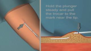 Jadelle insertion and removal Tutorial [upl. by Octavius]