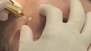 Removing warts how to [upl. by Anytsirhc818]