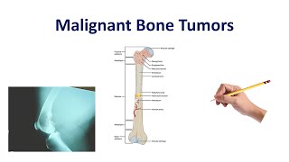 Bone and cartilage tumors [upl. by Denae]