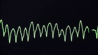 Cardiac arrest rhythms VF VT Asystole and PEA [upl. by Adnaerb496]