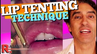 LIP FILLER RUSSIAN TENTING TECHNIQUE Demonstrated  Lip Filler Before and After [upl. by Llemert]