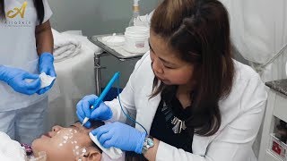 Warts removal Cautery [upl. by Cherrita]