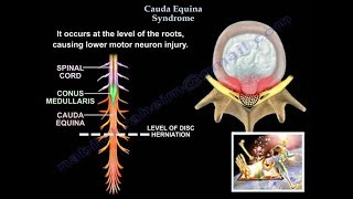 Spinal Cord Injury Detailed  Everything You Need To Know  Dr Nabil Ebraheim [upl. by Aynatan]