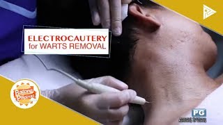 DERMAESTHETIQUE Electrocautery for warts removal [upl. by Onfroi881]