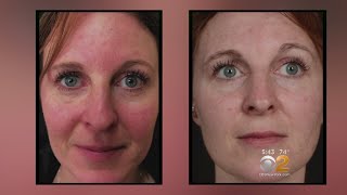 Health Watch New Laser Treatment For Rosacea [upl. by Merrel]