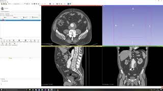 3D Slicer Tutorial 2 Manual segmentation Thresholding [upl. by Nanek]