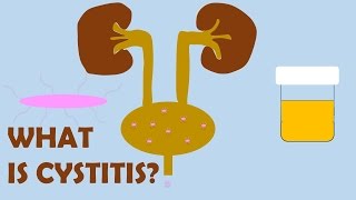 What is Cystitis [upl. by Gnim]