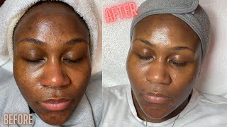 Hyperpigmentation Correction w Microdermabrasion [upl. by Lia978]