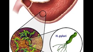 Helicobacter Pylori [upl. by Leehar]