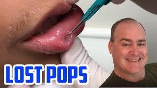 Dr Gilmores Lost Pops Cysts amp Pimples [upl. by Fullerton]