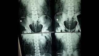 IVPIVU Intravenous UrographyPyelography BASICS OF RADIOGRAPH EXPLAINED [upl. by Ailices244]