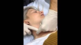 Sternocleidomastoid SCM Dry Needling [upl. by Ecnarolf]