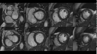 Arrhythmogenic Cardiomyopathy [upl. by Nevak289]