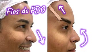 FIOS de PDO para empinar o NARIZ e levantar os OLHOS Fox Eyes [upl. by Amorette]