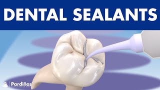 How to PREVENT CAVITIES  Dental sealants © [upl. by Knick881]