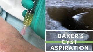 Simple Bakers Cyst Aspiration [upl. by Galitea]