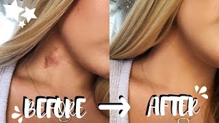 How To Get Rid Of Hickeys In Two EASY Steps no color correcting  Brooklyn Anne [upl. by Loma]