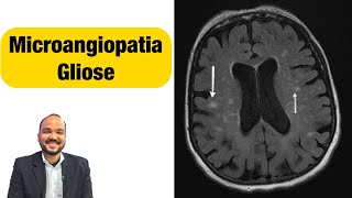 O que é Leucoencefalopatia microangiopática ou isquêmica   Ressonância Magnética [upl. by Ettenyl950]