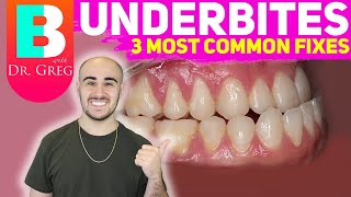 BRACES EXPLAINED Underbite  Crossbite Correction [upl. by Ecirahs]