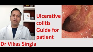 Ulcerative colitis Treatment and Symptoms अल्सरेटिव कोलाइटिस In Hindi Dr Vikas Singla [upl. by Lewls]