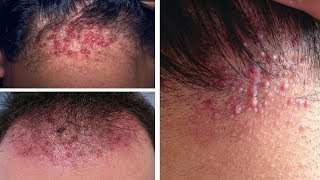 How to Treat Folliculitis on Scalp Naturally  8 Best Home Treatments for Folliculitis On Scalp [upl. by Fallon986]