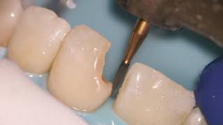 Teeth Bonding  Front tooth filling EXPLAINED [upl. by Ginsburg569]