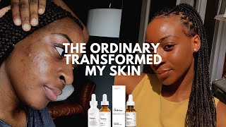 The Ordinary Skin Transformation Mandelic Acid Cleared My Acne  xoreni [upl. by Shel]