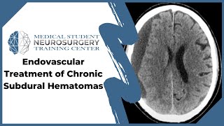 Endovascular Treatment of Chronic Subdural Hematomas [upl. by Nnayt702]