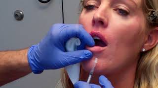 The MicroInjection Technique for Beautiful Lips [upl. by Odlanyar]