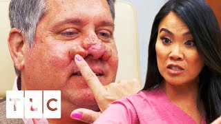 Treating A SEVERE Case Of Rhinophyma  Dr Pimple Popper [upl. by Anirbys83]