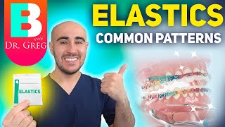 BRACES ELASTICS Most Common Patterns for Braces [upl. by Pompei]