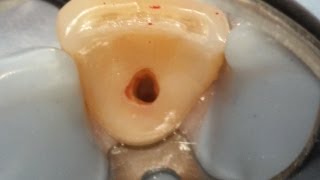 Internal resorption treatment with narration [upl. by Eillit]